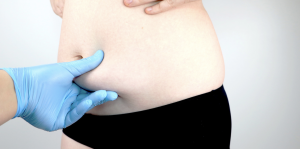 Virginia Beach 360 Liposuction Surgeon